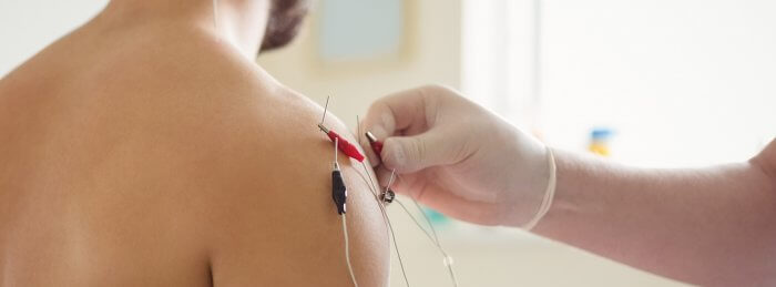 Triggerpunkt Behandlung mit Dry Needling